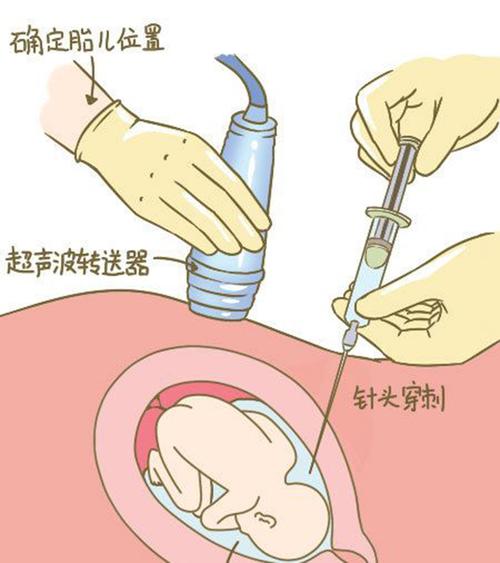 贵州羊水孕期亲子鉴定